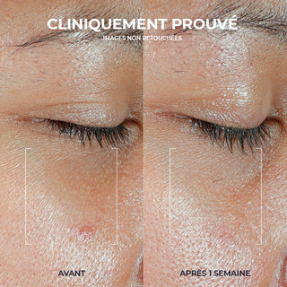 Side-by-side comparison of a person’s skin before and after one week of using RoC skincare, showing visible improvement in skin texture and clarity. Text in French reads: 'Clinically proven – images not retouched' with 'Avant' and 'Après 1 semaine' labels.