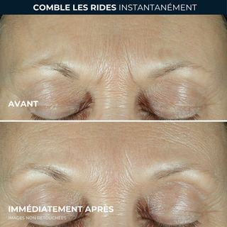 DERM CORREXION® Sérum Combler+Traiter